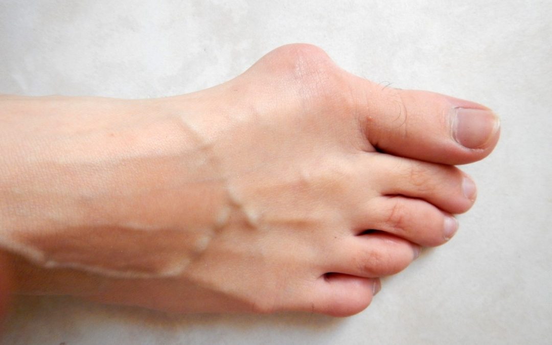 Hallux valgus